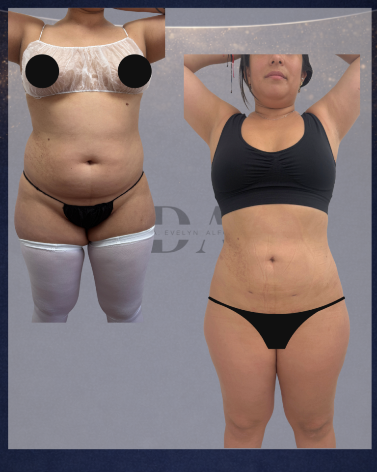 lipolaser-lipovaser-fullbody