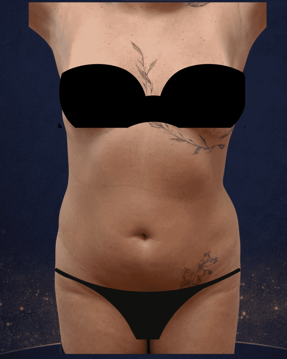 Paciente femenina antes de LipoVaser y LipoLaser en abdomen, flancos y brazos — Clínica Lumos, Viña del Mar