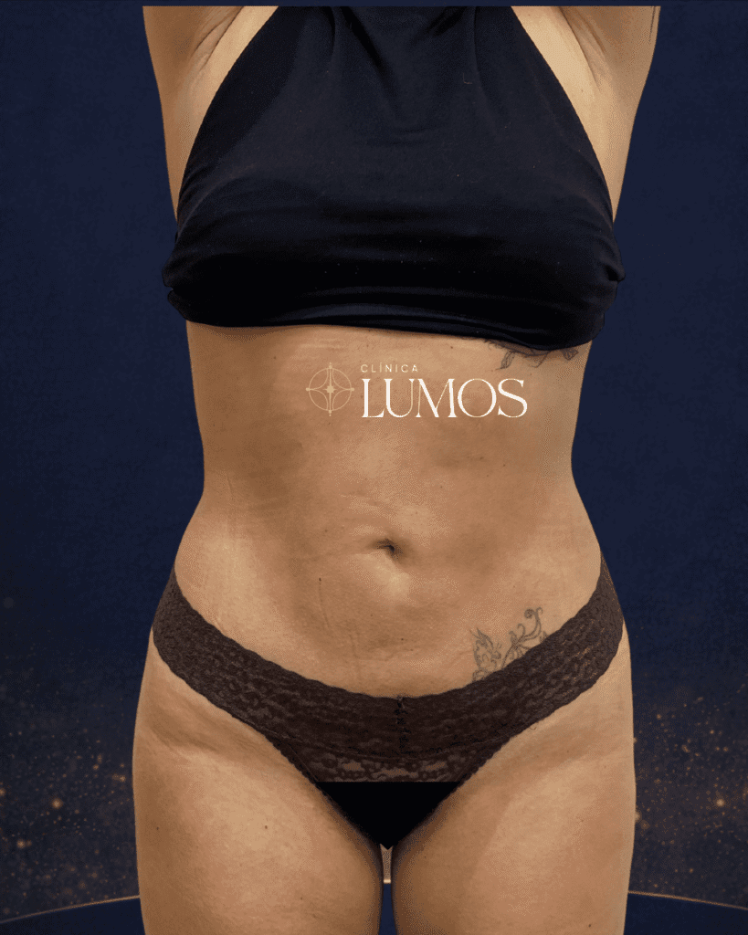 Resultado LipoVaser y LipoLaser en abdomen, flancos y brazos — Clínica Lumos, Dra. Alfonso, Viña del Mar