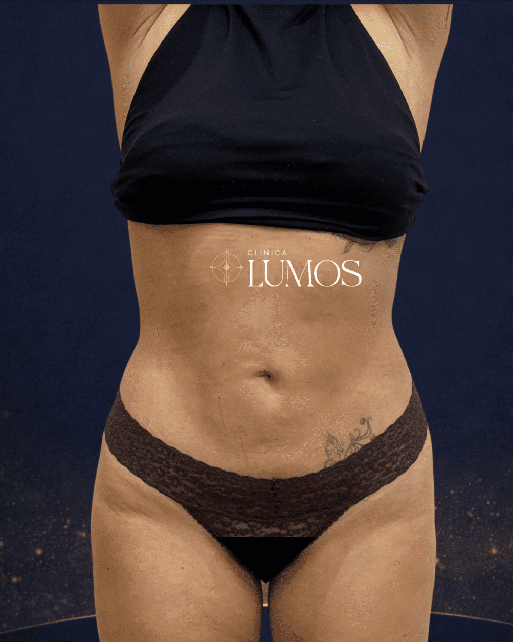 Resultado LipoVaser y LipoLaser en abdomen, flancos y brazos — Clínica Lumos, Dra. Alfonso, Viña del Mar