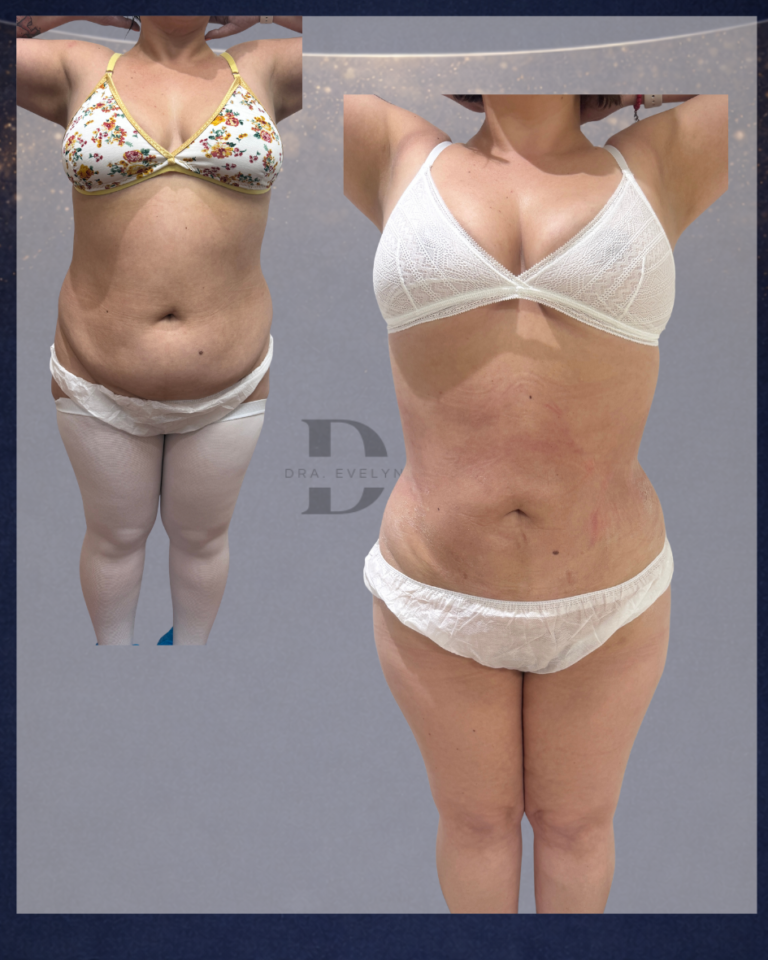 lipovaser-lipolaser-paciente-femenina-sin-necesidad-de-lipoabdomino