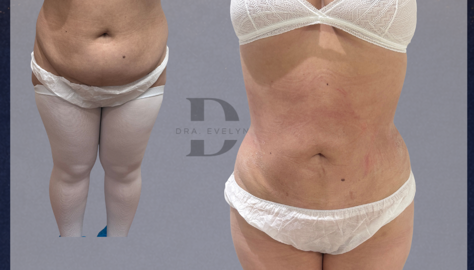 lipovaser-lipolaser-paciente-femenina-sin-necesidad-de-lipoabdomino