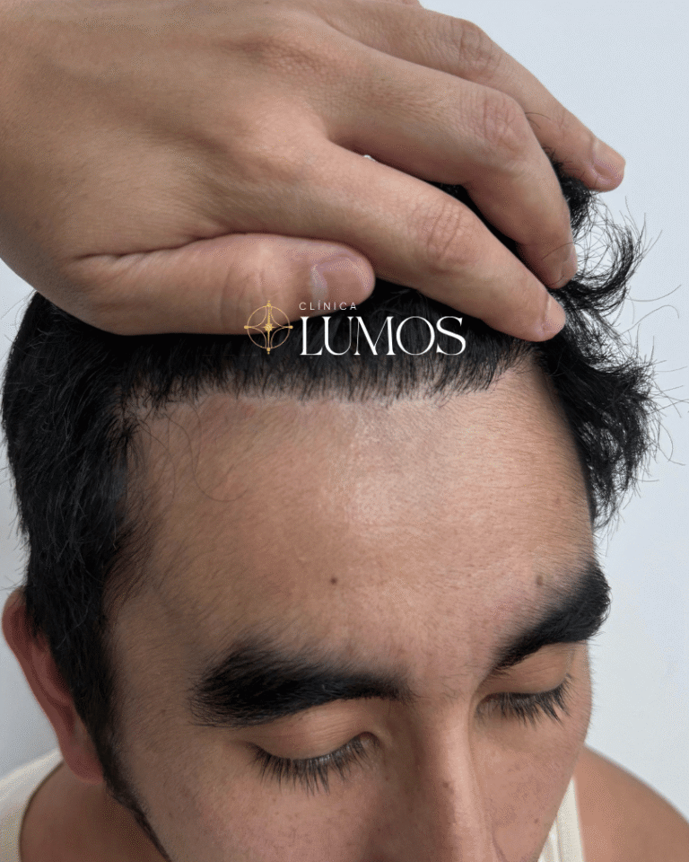 luego-de-10-meses-de-su-trasplante-capilar