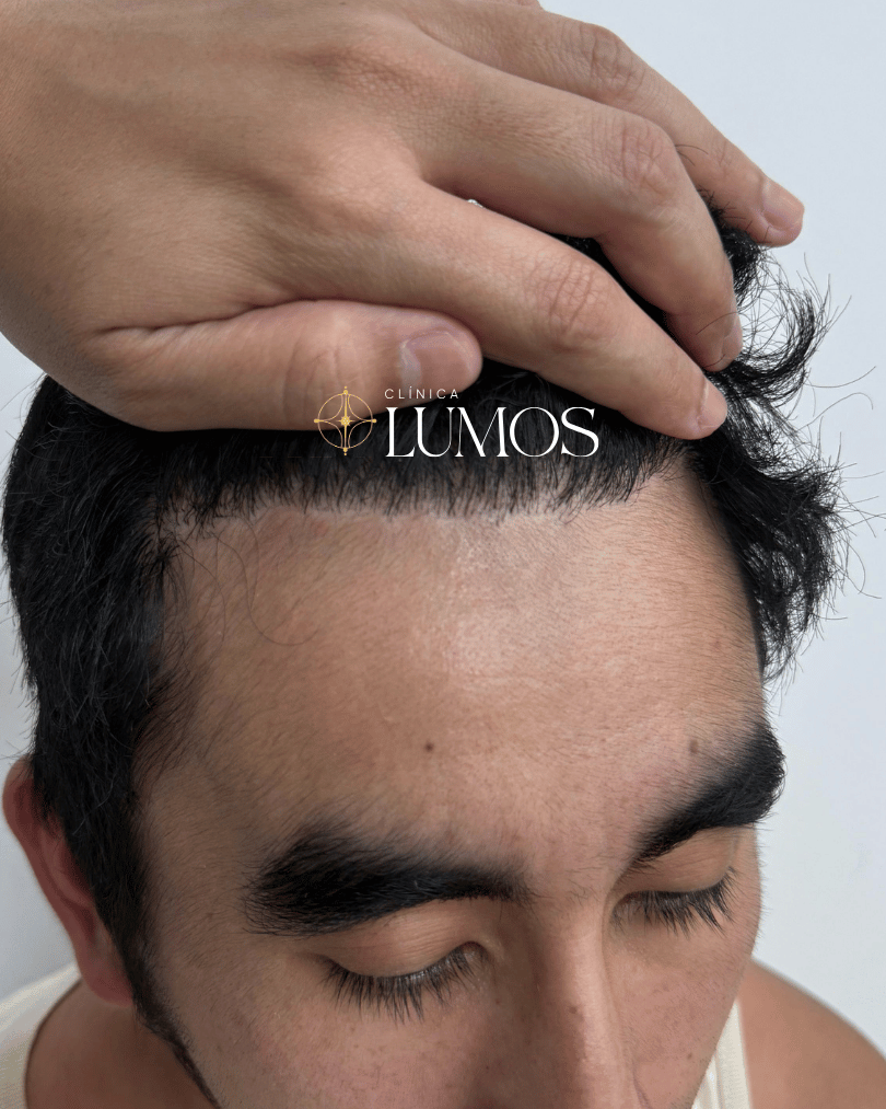 luego-de-10-meses-de-su-trasplante-capilar