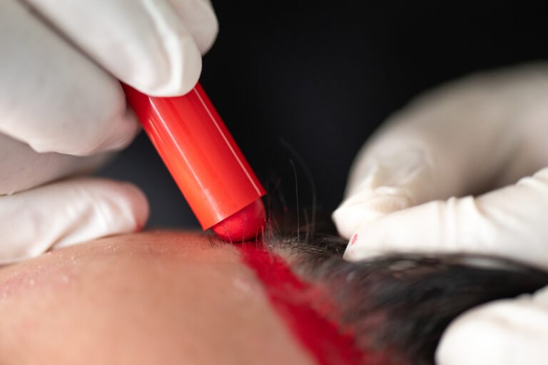 marcación de zona frontal previa al trasplante capilar FUE — Dra. Alfonso, Clínica Lumos Viña del Mar