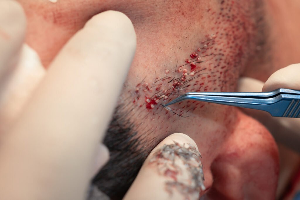 mejor-implante-de-barba