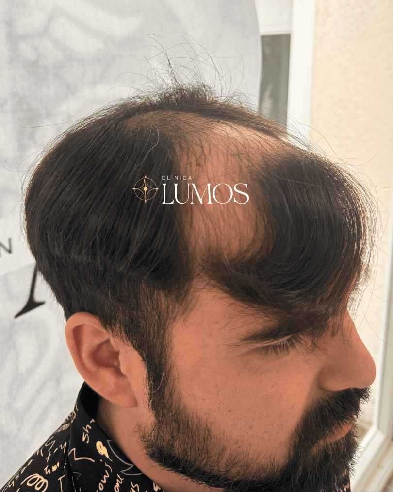 Hombre con pérdida de cabello notable.