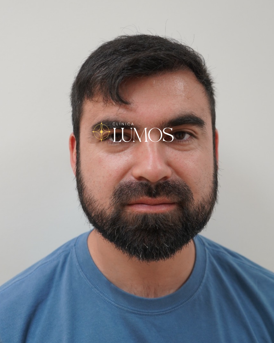 luego-trasplante-capilar